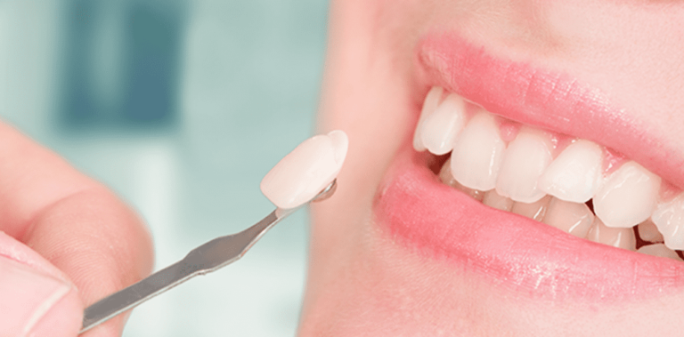 How Dental Veneers Can Change Your Smile