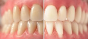Results of our at home teeth whitening in Raleigh