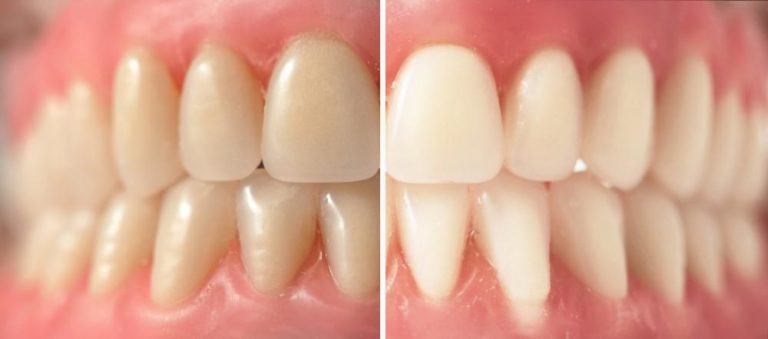 Results of our at home teeth whitening in Raleigh