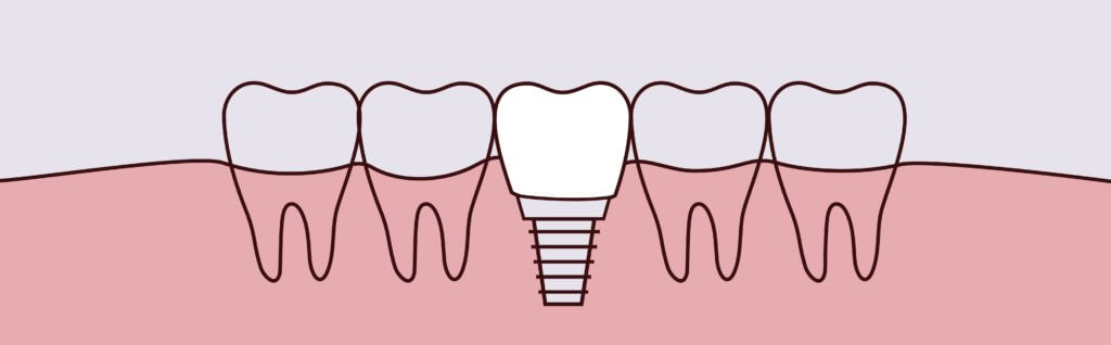 illustration of dental implants in Raleigh, NC