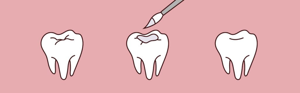 Illustration of a tooth being filled, showing the process from cavity to completion on a pink background