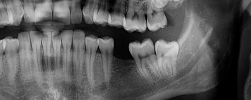 dental x-ray for tooth extraction in Raleigh, NC