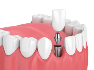 Illustration of how Raleigh dental implants look and work