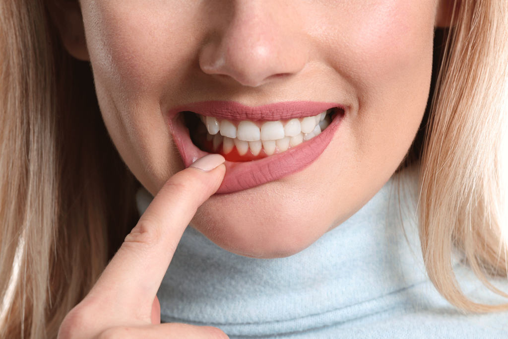 A woman pulling down her lip to reveal red, inflamed gums